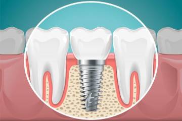 Różnica między protezą a implantem zębowym